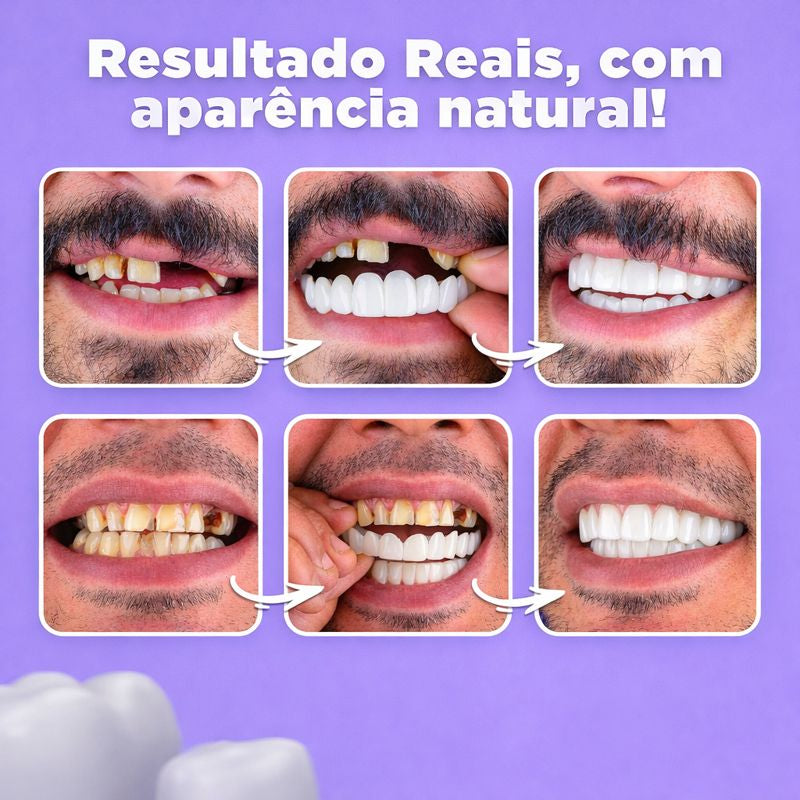 Facetas Dentárias Removíveis