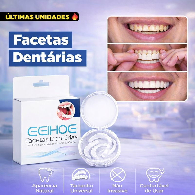 Facetas Dentárias Removíveis